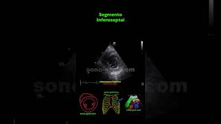 Ecocardiografía  Hipocinesia Inferolateral E Inferior [upl. by Wan]