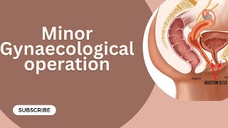 Minor Gynaecological operations  Gynaecology Lecture  part 18 [upl. by Nitsugua]