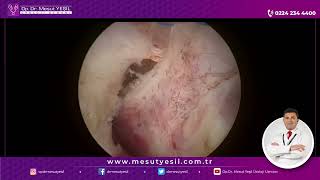 80 CC PROSTATE HOLMIUM LASER ENUCLEATION HOLEP WITH MIDDLE LOBE NO BLEEDING FULL VIDEO 1080p [upl. by Adlitam]