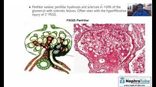 Minimal Change Disease amp Focal Segmental Glomerulosclerosis Arabic Version [upl. by Etteniotnna153]