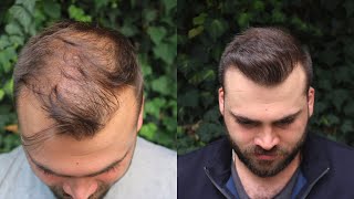 Hair Transplant Result with 3040 Grafts  EXTREME TRANSFORMATION from 0 days to 10 Months [upl. by Enylorac]