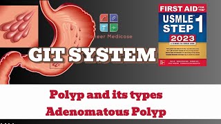 USMLE Step1 Polyp and its types Adenomatous Polyps from first aid step 1USMLEUrduHindi [upl. by Swiercz902]