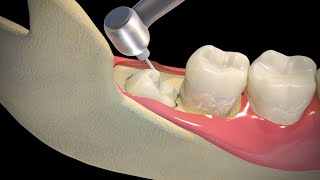 Wisdom Teeth Extraction  Step by step [upl. by Scrivings]