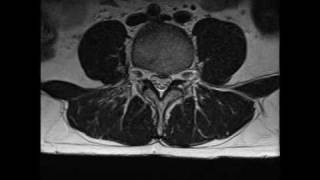 MRI of lumbar spine L4 L5 S1 disc bulge [upl. by Nerrak]