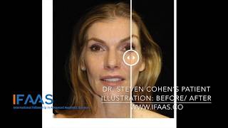 IFAAS Exclusive Techniques  Dr Steven Cohen Patients Illustration BeforeAfter [upl. by Ajiam]