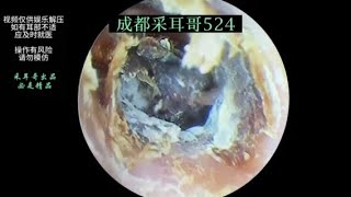 采耳哥Ear wax removalsatisfying video for ear Fungus cleaning  524 [upl. by Buck]