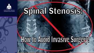 Top 5 Lumbar Spinal Stenosis Exercises amp Stretches  Ask Doctor Jo [upl. by Elexa]