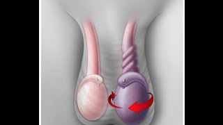 Testicular Torsion [upl. by Yanrahc]