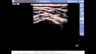 bursitis trocanterea [upl. by Politi]