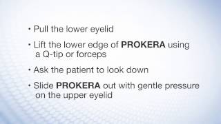 BioTissue PROKERA® Insertion amp Removal [upl. by Ametaf938]