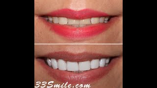 Cosmetic Dentistry Prepless Dental Veneers Before and After [upl. by Jamin500]