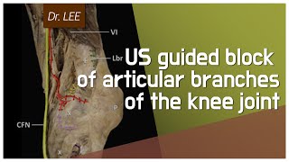 TKnee osteoarthritis Ultrasoundguided block of the knee joint articular branches [upl. by Yekciv816]