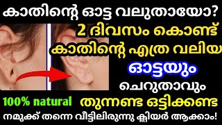 എത്ര ഭാരമുള്ള കമ്മലിട്ടാലും കാത് തൂങ്ങില്ലകാതിന്റെ വലുതായഓട്ട അടയുകയും ചെയ്യും Reduce Earring Hole [upl. by Albion598]