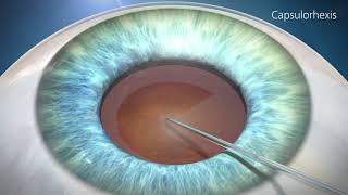 Cataract Surgery Animation [upl. by Florry99]