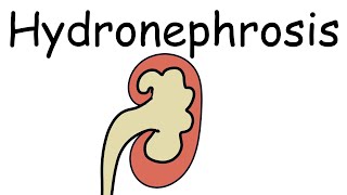 What is Hydronephrosis Causes Presentation Complications and Treatment  Pathology mini tutorials [upl. by Barb]