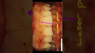 Laser gingivectomy [upl. by Volpe]