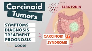 Carcinoid Tumor  Visual Explanation  Symptoms diagnosis treatment prognosis [upl. by Etka]