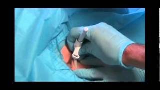 Cricothyroidotomy Surgical [upl. by Aihsena]