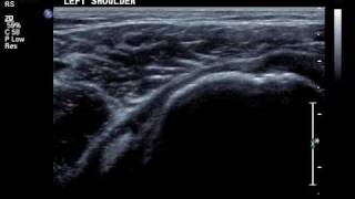 relocating biceps tendon [upl. by Leemaj]