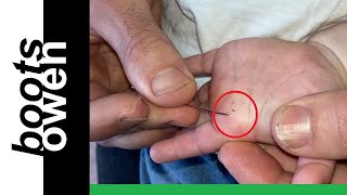 how to remove a thorn or splinter in the soft flesh of a babys hand no pain easy [upl. by Niran]