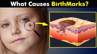 Birthmarks  How Birth Marks Develops In Our Skin UrduHindi [upl. by Card]