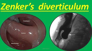 Zenkers diverticulum Symptoms Causes Diagnosis Treatment Complications and How it Occur [upl. by Vernice]