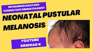 Neonatal pustular melanosisa dermatologists perspective rash newbornrash pustularmelanosis [upl. by Eniarral520]