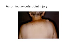 Acromioclavicular Joint Injury [upl. by Kiri]