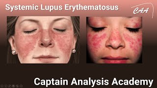 E14 Systemic Lupus Erythematosus كل حاجة عن الذئبة الحمراء من الالف للياء التشخيص [upl. by Meekahs742]