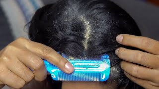 Scratching Dandruff Off Scalp Dry Scalp Psoriasis Huge Flakes [upl. by Yasu]