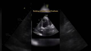 Rocking of Mitral Prosthesis echocardiography cardiology shorts heartcondition [upl. by Ayekim627]