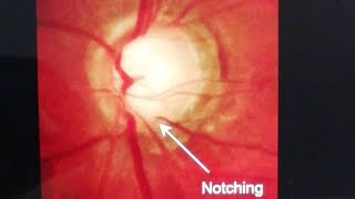 Primary Open Angle Glaucoma [upl. by Ynohtona]