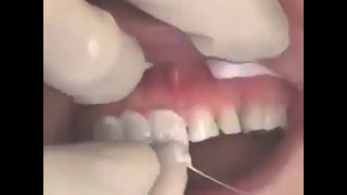 Închiderea diastemei prin faţete ceramiceDiastema closure with ceramic veneers [upl. by Conlen]