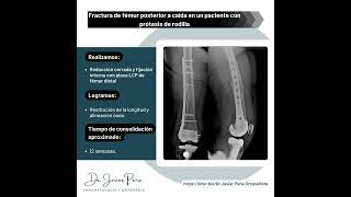 Fractura de fémur en paciente con prótesis total de rodilla  Dr Javier Peña Chávez [upl. by Ummersen]