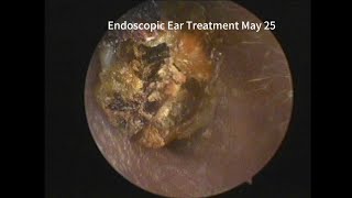 Common cerumen embolism and cholesteatoma20230525 [upl. by Mungo]