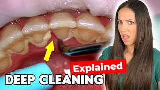 Dental Hygienist Explains Deep Cleaning Procedure [upl. by Fagan]