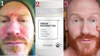 how I CURED ECZEMA  DERMATITIS washing my face with COCONUT OIL [upl. by Sewell]