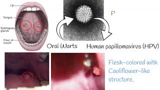 Oral Papilloma  Symptoms causes treatment [upl. by Nomannic]