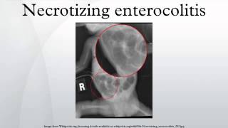 Necrotizing enterocolitis [upl. by Zat]