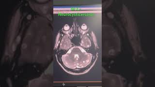 NCC NeurocysticercosisMRI Brain [upl. by Tur]