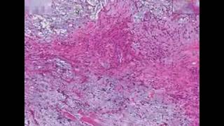 Histopathology Salivary glandPleomorphic adenoma mixed tu [upl. by Yrdua]