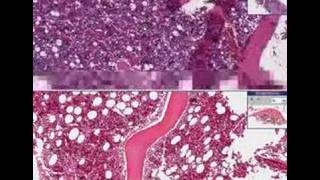 Histopathology Bone marrow  adenocarcinoma metastatic [upl. by Nolasba]