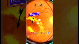 Diabetic Retinopathy  CSME  Retina  Short Video 170 akleshkumar optometrist [upl. by Aneram756]