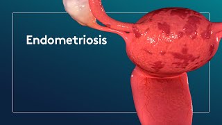 What is Endometriosis [upl. by Hildegarde623]