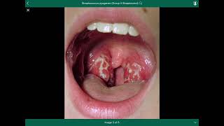 streptococcus pyogenes  العقدية القيحية [upl. by Gilud]