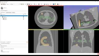 Create DICOM files from CT volume and segmentation [upl. by Hannahoj]