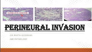 Perineural Invasion SCC  Simplified explanation  Images [upl. by Longtin]