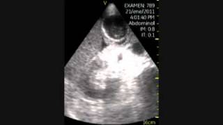 VSCAN Cholecystitis pocket ultrasound Colecistitis aguda eco de bolsillo [upl. by Ees]