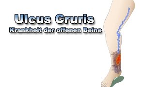 Ulcus Cruris  Krankheiten der Blutgefäße  Pflege Kanal [upl. by Omrellig835]