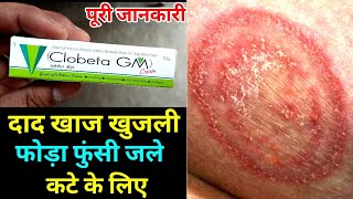 Clobeta gm cream uses or side effects in hindi  clobenate gm cream uses in hindi [upl. by Atikal289]